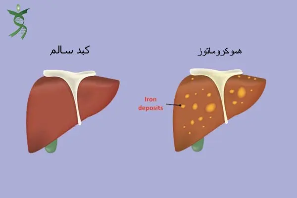 بیماری هموکروماتوز ارثی
