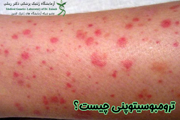 ترومبوسیتوپنی چیست
