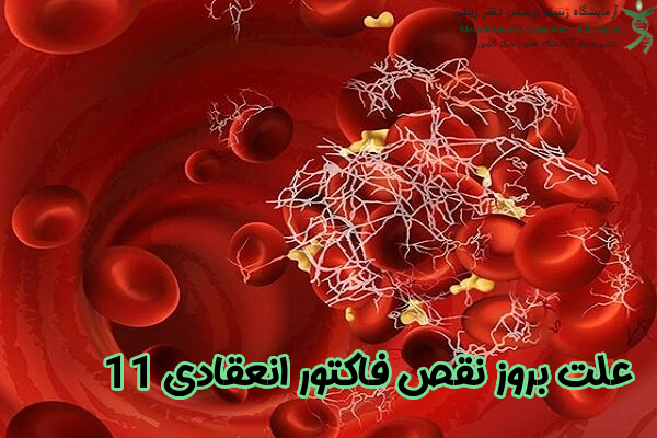 علت بروز نقص فاکتور انعقادی 11