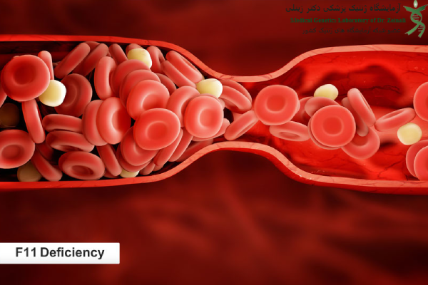 نقص فاکتور انعقادی 11 چیست