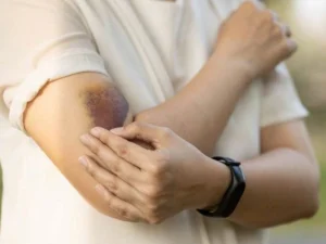 سندرم برنارد سولیر