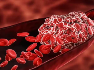 نقص فاکتور انعقادی 10