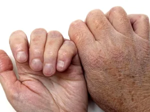 سندروم چانارین-دورفمن