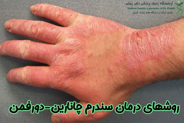 درمان سندرم چانارین-دورفمن