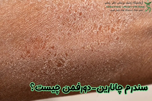 سندرم چانارین-دورفمن چیست؟