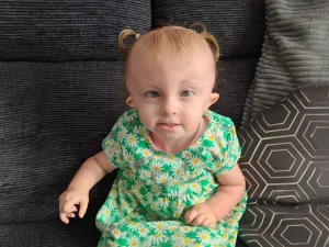 سندرم ادوارد