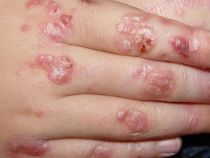 سندرم کیندلر