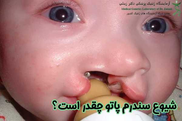 شیوع سندرم پاتو