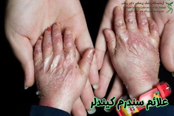 علائم سندرم کیندلر