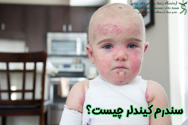 سندرم کیندلر چیست؟