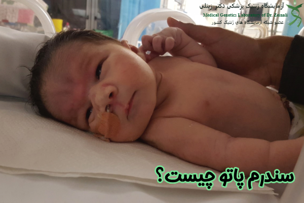 سندرم پاتو چیست